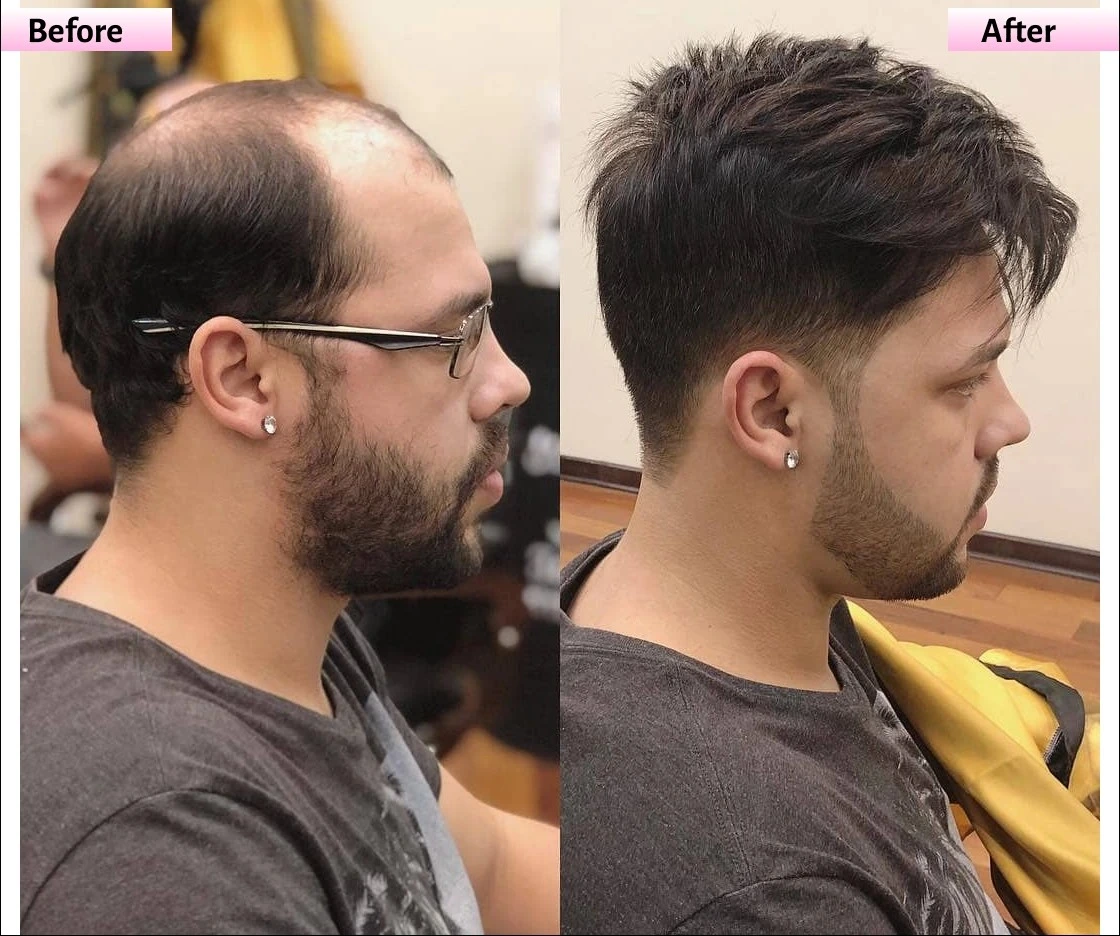 Front Tape and Clip Hair Patch Service in Hyderabad at B The Best Hair Studio
